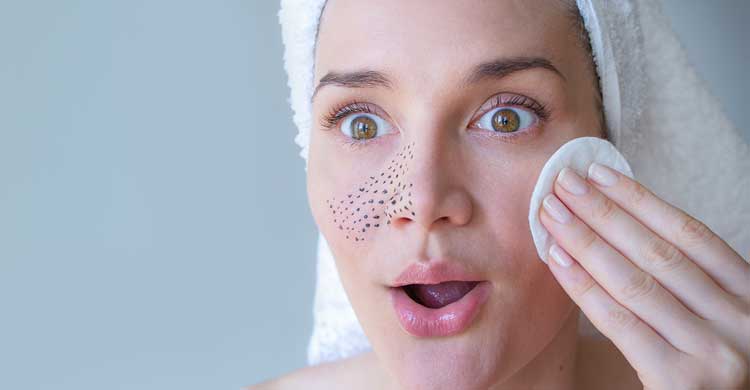 Les meilleurs traitements des points noirs selon les dermatologues