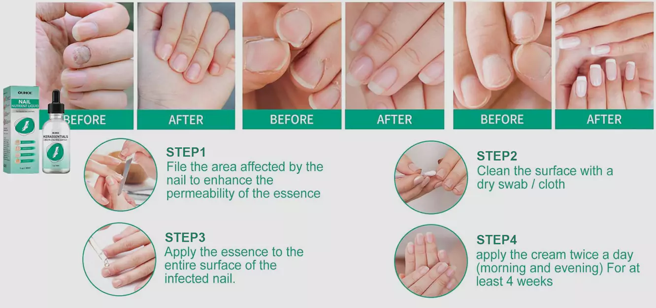 kerassentials reviews 4 - how to apply