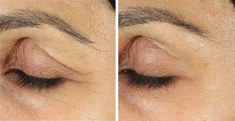 Crème pour les yeux RoC Retinol Correxion avant et après