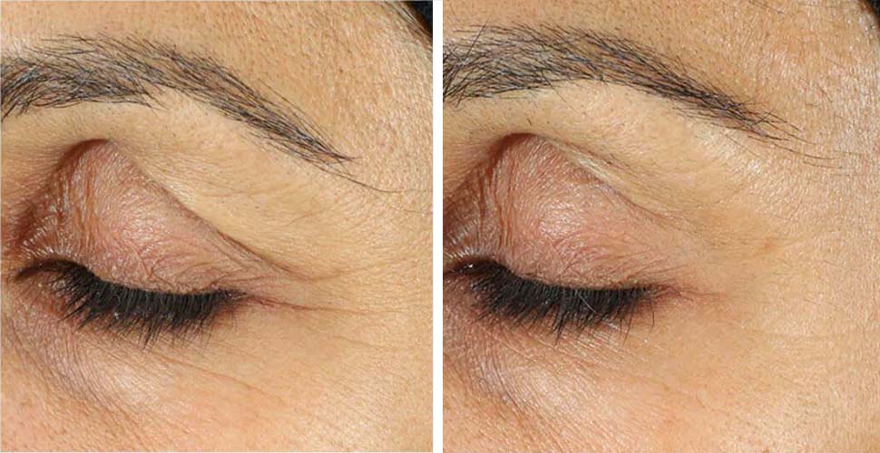 Crema para ojos RoC Retinol Correxion antes y después